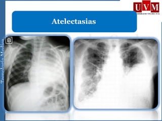 Atelectasias
 