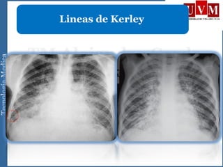 Lineas de Kerley
 