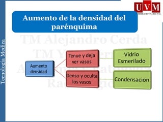 Aumento de la densidad del
parénquima
 