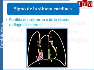 • Perdida del contorno o de la silueta
radiografica normal
Signo de la silueta cardiaca
 