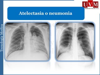 Atelectasia o neumonia
 