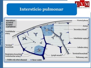 Intersticio pulmonar
 