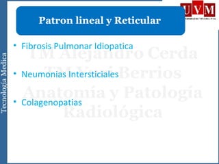 • Fibrosis Pulmonar Idiopatica
• Neumonias Intersticiales
• Colagenopatias
Patron lineal y Reticular
 