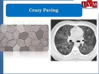 Crazy Paving
 