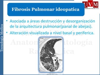 • Asociada a áreas destrucción y desorganización
de la arquitectura pulmonar(panal de abejas).
• Alteración visualizada a nivel basal y periferica.
Fibrosis Pulmonar ideopatica
 