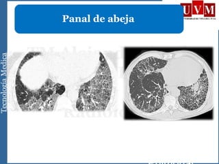 UIP Fibrosis
Panal de abeja
 