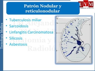 • Tuberculosis miliar
• Sarcoidosis
• Linfangitis Carcinomatosa
• Silicosis
• Asbestosis
Patrón Nodular y
reticulonodular
 