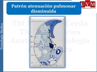 Patrón atenuación pulmonar
disminuida
 