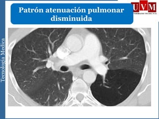 Patrón atenuación pulmonar
disminuida
 