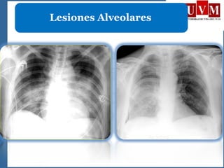 Lesiones Alveolares
 