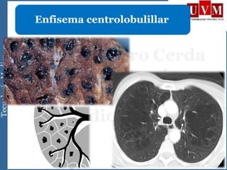 Enfisema centrolobulillar
 