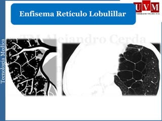 Enfisema Retículo Lobulillar
 