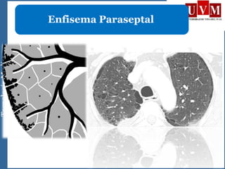Enfisema Paraseptal
 