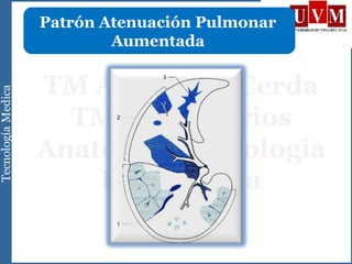 Patrón Atenuación Pulmonar
Aumentada
 