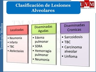 Clasificación de Lesiones
Alveolares
 