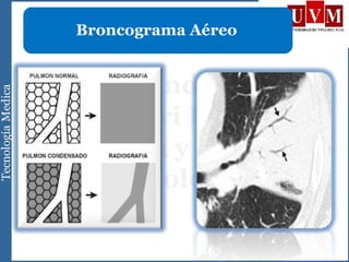 Broncograma Aéreo
 