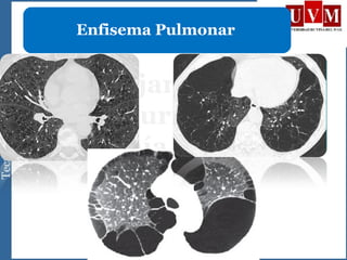 Enfisema Pulmonar
 