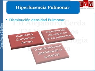 • Disminución densidad Pulmonar
Hiperlucencia Pulmonar
 