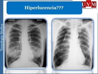Hiperlucencia???
 