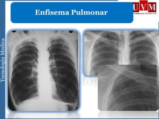Enfisema Pulmonar
 