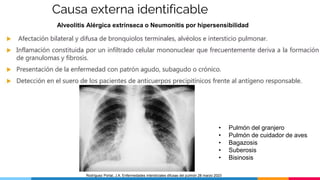 Causa externa identificable
Alveolitis Alérgica extrínseca o Neumonitis por hipersensibilidad
• Pulmón del granjero
• Pulmón de cuidador de aves
• Bagazosis
• Suberosis
• Bisinosis
Rodríguez Portal, J.A. Enfermedades intersticiales difusas del pulmón 28 marzo 2023
 