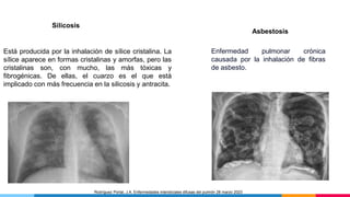Silicosis
Está producida por la inhalación de sílice cristalina. La
sílice aparece en formas cristalinas y amorfas, pero las
cristalinas son, con mucho, las más tóxicas y
fibrogénicas. De ellas, el cuarzo es el que está
implicado con más frecuencia en la silicosis y antracita.
Asbestosis
Enfermedad pulmonar crónica
causada por la inhalación de fibras
de asbesto.
Rodríguez Portal, J.A. Enfermedades intersticiales difusas del pulmón 28 marzo 2023
 