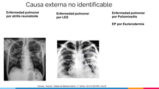 Causa externa no identificable
Enfermedad pulmonar
por atritis reumatoide
Enfermedad pulmonar
por LES
Enfermedad pulmonar
por Poliomiositis
EP por Esclerodermia
Farreras, Rozman: Tratado de Medicina Interna. 17° edición. 2012 ELSEVIER. Cap 20
 