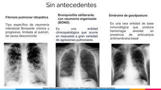 Sin antecedentes
Fibrosis pulmonar idiopática
Tipo específico de neumonía
intersticial fibrosante crónica y
progresiva, limitada al pulmón,
de causa desconocida
Bronquiolitis obliterante
con neumonía organizada
(BONO)
Es una entidad
clínicopatológica que ocurre
en respuesta a gran variedad
de agresiones pulmonares.
Síndrome de goodpasture
Es una rara entidad de base
inmunológica que produce
hemorragia alveolar en
presencia de anticuerpos
antimembrana basal
Mosca,Carlos,Quadrelli,silvia. Castanni,jorge. EPID,Argentina revista medicina respiratoria
 