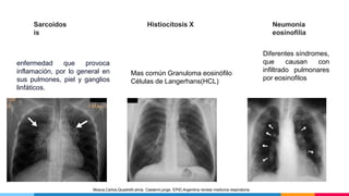 Sarcoidos
is
enfermedad que provoca
inflamación, por lo general en
sus pulmones, piel y ganglios
linfáticos.
Histiocitosis X
Mas común Granuloma eosinófilo
Células de Langerhans(HCL)
Neumonía
eosinofilia
Diferentes síndromes,
que causan con
infiltrado pulmonares
por eosinofilos
Mosca,Carlos,Quadrelli,silvia. Castanni,jorge. EPID,Argentina revista medicina respiratoria
 