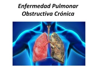 Enfermedad Pulmonar
Obstructiva Crónica
Manejo crónica
 