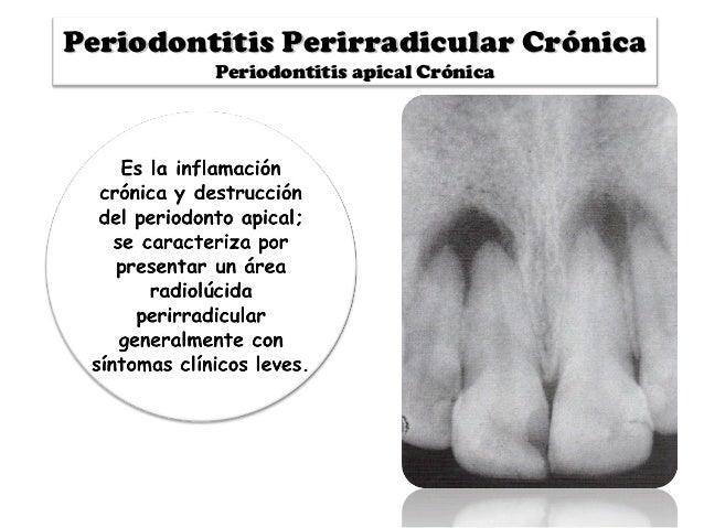 Periodontitis apical cronica pdf
