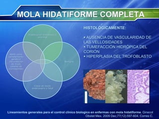 MOLA HIDATIFORME COMPLETA
Proliferación trofoblastica
anormal
Benigna
Crece de tejido
embrionario o fetal
46XX como
complemento
genético
(fecundación
de óvulo
carente de
cromosomas)
Lineamientos generales para el control clinico biologico en enfermas con mola hidatiforme. Ginecol
Obstet Mex. 2009 Dec;77(12):597-604. Corres C.
HISTOLÓGICAMENTE:
 AUSENCIA DE VASCULARIDAD DE
LAS VELLOSIDADES
 TUMEFACCIÓN HIDRÓPICA DEL
CORIÓN
 HIPERPLASIA DEL TROFOBLASTO
 