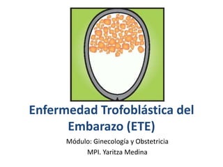 Enfermedad Trofoblástica del
Embarazo (ETE)
Módulo: Ginecología y Obstetricia
MPI. Yaritza Medina
 