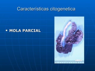 Características  citogenetica  MOLA PARCIAL 