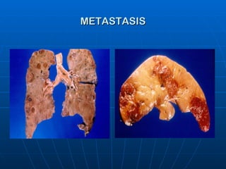 METASTASIS 