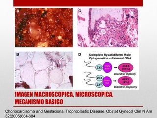 MOLA COMPLETA
IMAGEN MACROSCOPICA, MICROSCOPICA,
MECANISMO BASICO
Choriocarcinoma and Gestacional Trophoblastic Disease. Obstet Gynecol Clin N Am
32(2005)661-684
 