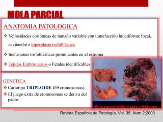 MOLA PARCIAL
ANATOMIA PATOLOGICA
 Vellosidades coriónicas de tamaño variable con tumefacción hidatiforme focal,
cavitación e hiperplasia trofoblástica
 Inclusiones trofoblásticas prominentes en el estroma
 Tejidos Embrionarios o Fetales identificables.
Revista Española de Patología. Vol. 35, Num 2;2003
GENETICA
 Cariotipo TRIPLOIDE (69 cromosomas).
 El juego extra de cromosomas se deriva del
padre.
 