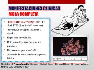 MANIFESTACIONES CLINICAS
MOLA COMPLETA
 HEMORRAGIA VAGINAL 84 % DE
LAS PTES (1ra mitad del embarazo)
 Separación de tejido molar de la
decidua.
 Expulsión de vesículas.
 Retención de sangre (volúmenes
grandes).
 Hiperémesis gravídica 30%.
 Ausencia de tonos cardiacos y partes
fetales.
Gestational Trophoblastic Disease (Clinical Expert Series).Obstet Gynecol, Volume
108(1). July 2006(176-187)
 