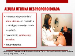 ALTURA UTERINA DESPROPORCIONADA
Aumento exagerado de la
altura uterina con respecto a
la edad gestacional (45% de
las pctes).
Crecimiento trofoblástico
excesivo.
Sangre retenida
Gestational Trophoblastic Disease (Clinical Expert Series).Obstet Gynecol, Volume
108(1). July 2006(176-187)
 