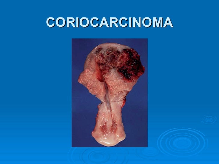 gestational trophoblastic disease