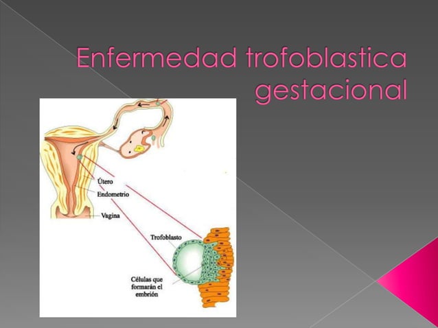 Enfermedad trofoblastica gestacional | PPT
