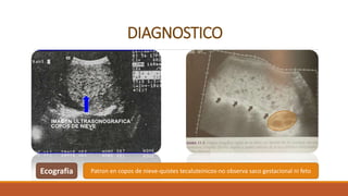 DIAGNOSTICO
Ecografia Patron en copos de nieve-quistes tecaluteinicos-no observa saco gestacional ni feto
 