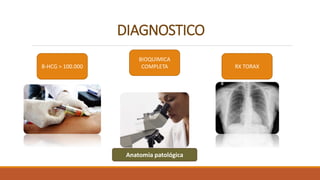 DIAGNOSTICO
B-HCG > 100.000
BIOQUIMICA
COMPLETA RX TORAX
Anatomia patológica
 