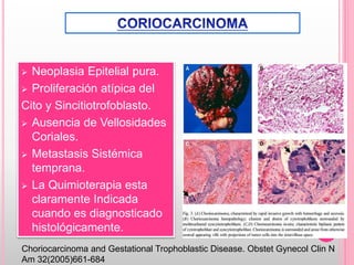  Neoplasia Epitelial pura.
 Proliferación atípica del
Cito y Sincitiotrofoblasto.
 Ausencia de Vellosidades
Coriales.
 Metastasis Sistémica
temprana.
 La Quimioterapia esta
claramente Indicada
cuando es diagnosticado
histológicamente.
Choriocarcinoma and Gestational Trophoblastic Disease. Obstet Gynecol Clin N
Am 32(2005)661-684
 