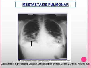 Gestational Trophoblastic Disease(Clinical Expert Series).Obstet Gynecol, Volume 108
 