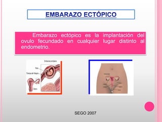 Embarazo ectópico es la implantación del
ovulo fecundado en cualquier lugar distinto al
endometrio.
SEGO 2007
 