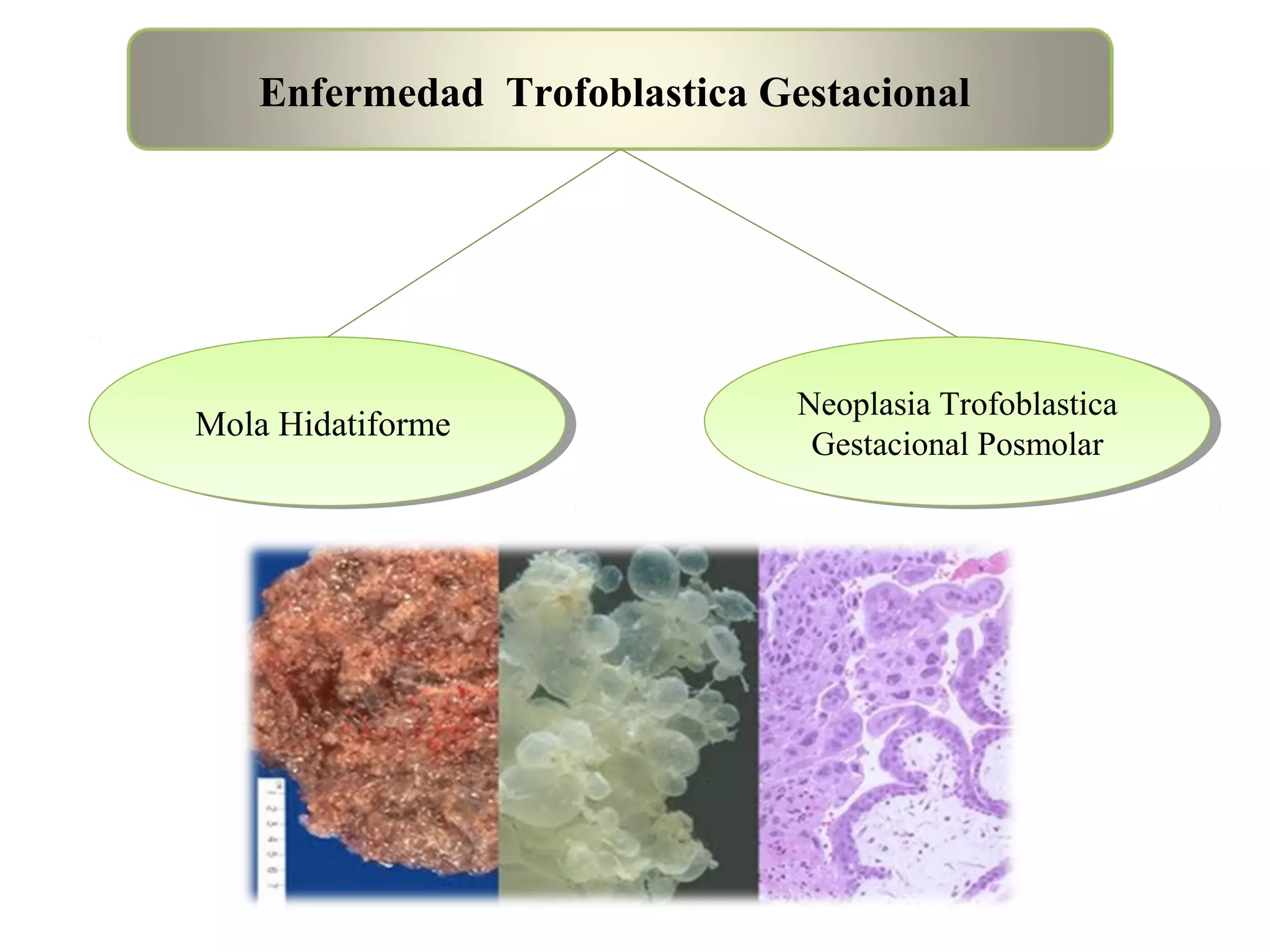 Enfermedad trofoblastica gestacional | PPT