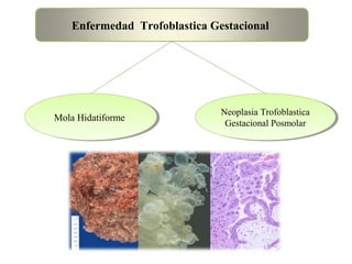 Enfermedad Trofoblastica Gestacional
Mola HidatiformeMola Hidatiforme
Neoplasia Trofoblastica
Gestacional Posmolar
Neoplasia Trofoblastica
Gestacional Posmolar
 