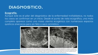 DIAGNOSTICO.
Ecografía.
Aunque este es el pilar del diagnóstico de la enfermedad trofoblástica, no todos
los casos se confirman en un inicio. Desde el punto de vista ecográfico, una mola
completa aparece como una masa uterina ecogénica con numerosos espacios
quísticos anecoicos pero sin feto o saco amniótico.
 