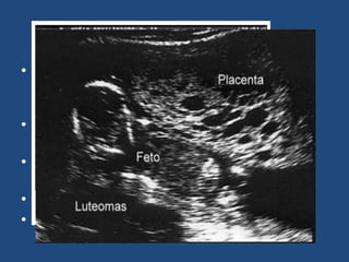 Mola Parcial
• Presenta características de una placenta de
desarrollo normal y de una mola hidatiforme
completa.
• Gama de vellosidades desde normales a
quísticas.
• La hiperplasia del trofoblasto es focal o en
parches.
• Afecta al sincitiotrofoblasto.
• Puede estar presente el feto.
 